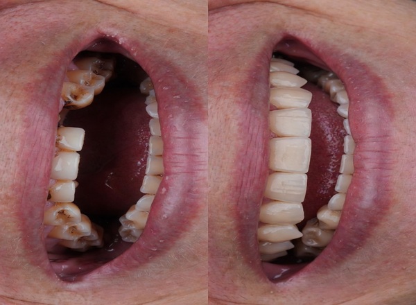 Rehabilitación Oral Antes y Después